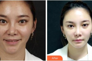 杭州時(shí)光醫(yī)療美容醫(yī)院KevinTeng整形價(jià)格表附埋線提升案例展示