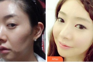 杭州格萊美整形美容醫(yī)院劉魏魏整形價(jià)格表附埋線提升案例展示