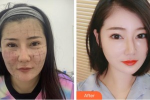 杭州藝星醫(yī)療美容醫(yī)院付德剛整形價(jià)格表附熱瑪吉案例展示