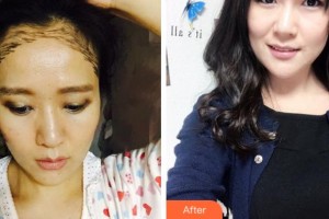 杭州雍禾植發(fā)醫(yī)院張東宏整形價(jià)格表附種植發(fā)際線案例展示