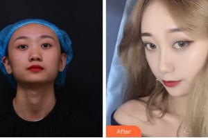 杭州韓佳醫(yī)療整形門診部樸相恩整形價(jià)格表附鼻部綜合案例展示
