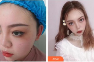 杭州韓佳醫(yī)療整形門診部柳垣在整形價(jià)格表附鼻部綜合案例展示