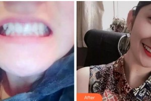 杭州維多利亞醫(yī)療美容醫(yī)院吳品芳整形價(jià)格表附牙齒隱形矯正案例展示