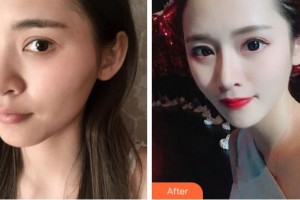 杭州維多利亞醫(yī)療美容醫(yī)院方葉琴整形價格表附假體隆鼻案例展示