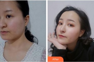 杭州艾菲醫(yī)療美容門診部樸元基整形價格表附埋線提升案例展示