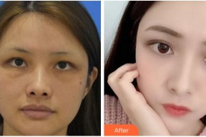 杭州顏術(shù)悅?cè)葆t(yī)療美容診所嚴后友整形價格表附埋線提升案例展示