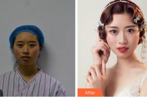 杭州顏術(shù)悅?cè)葆t(yī)療美容診所宋為民整形價格表附埋線提升案例展示