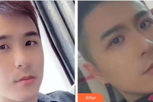 杭州珍美顏醫(yī)療美容診所陳濤整形價格表附眼部綜合案例展示