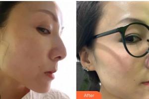 杭州格萊美整形美容醫(yī)院金鳳茹整形價格表附埋線提升案例展示