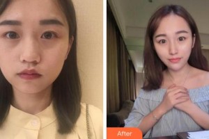 杭州麗星醫(yī)療美容診所薛少真整形價格表附熱瑪吉案例展示