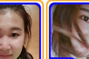 杭州冰美醫(yī)療美容醫(yī)院徐一波整形價格表附硅膠隆鼻案例展示