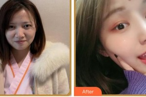杭州朝聚眼科醫(yī)院李春明整形價(jià)格表附眼部綜合案例展示