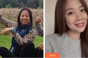 杭州達(dá)侖口腔門(mén)診部方朝榮整形價(jià)格表附金屬托槽矯正案例展示