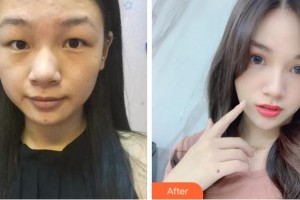 杭州朝聚眼科醫(yī)院金姬整形價(jià)格表附切開(kāi)雙眼皮案例展示