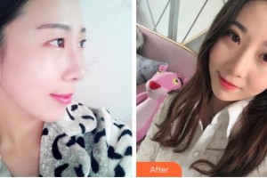 杭州朝聚眼科醫(yī)院楊亞波整形價(jià)格表附眼部綜合案例展示