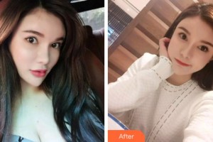 杭州美奧口腔門(mén)診部杜永濤整形價(jià)格表附超聲波潔牙案例展示