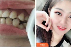 杭州美奧口腔門(mén)診部蔡明霏整形價(jià)格表附金屬托槽矯正案例展示