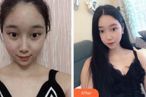 杭州求是眼科醫(yī)院顏偉年整形價(jià)格表附切開(kāi)雙眼皮案例展示