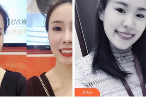 杭州牙科醫(yī)院林亨哲整形價(jià)格表附牙齒隱形矯正案例展示