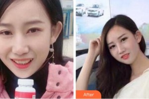 杭州協(xié)友口腔門(mén)診部金亭曼整形價(jià)格表附牙齒隱形矯正案例展示