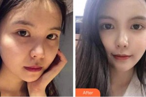 杭州依萱綺醫(yī)療美容診所李營(yíng)整形價(jià)格表附熱瑪吉案例展示