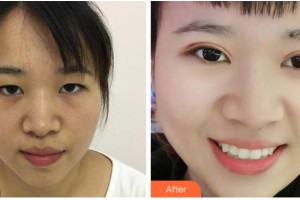 杭州華廈眼科醫(yī)院陳偕穗整形價(jià)格表附定點(diǎn)雙眼皮案例展示