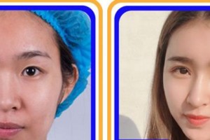 杭州華廈眼科醫(yī)院孫佳黎整形價(jià)格表附眼部綜合案例展示