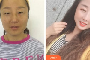 杭州富陽(yáng)柏氏眼科醫(yī)院馬麗卿整形價(jià)格表附內(nèi)切祛眼袋案例展示