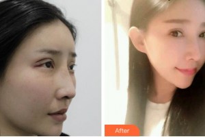 杭州德視佳眼科門診部薛艷珍整形價(jià)格表附切開雙眼皮案例展示