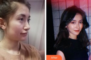 杭州富陽(yáng)柏氏眼科醫(yī)院謝毅杰整形價(jià)格表附眼部綜合案例展示