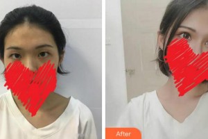 杭州富陽(yáng)柏氏眼科醫(yī)院王劍勇整形價(jià)格表附切開雙眼皮案例展示