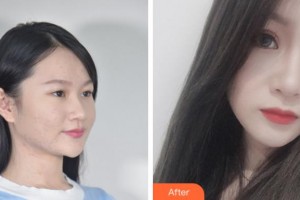 杭州求是眼科醫(yī)院平整形價(jià)格表附眼部綜合案例展示