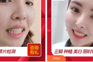 杭州品凱口腔醫(yī)院沈惠華整形價(jià)格表附貴金屬烤瓷牙案例展示