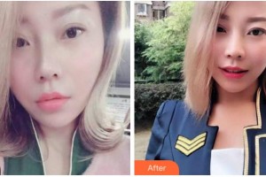 杭州品凱口腔醫(yī)院陳亮整形價(jià)格表附牙齒隱形矯正案例展示