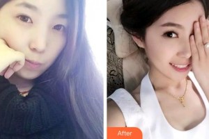 杭州品凱口腔醫(yī)院陳閏香整形價(jià)格表附牙齒隱形矯正案例展示