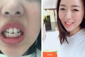 杭州品凱口腔醫(yī)院李宏偉整形價格表附金屬托槽矯正案例展示