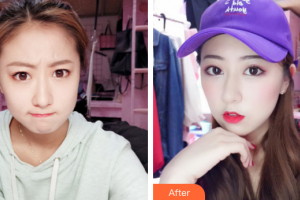 廣州市中西醫(yī)結(jié)合醫(yī)院燒傷整形外科劉移峰整形價格表附微針?biāo)獍咐故?>
</a>
<h3 class=