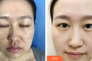 廣州市中西醫(yī)結(jié)合醫(yī)院燒傷整形外科林桂清整形價格表附微針美膚案例展示