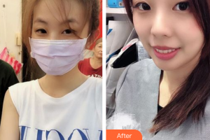 廣州市中西醫(yī)結(jié)合醫(yī)院燒傷整形外科黃錦剛整形價格表附光子嫩膚案例展示