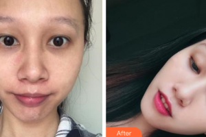 中信惠州醫(yī)院醫(yī)學(xué)整形中心楊光成整形價格表附微針美膚案例展示