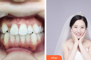 中信惠州醫(yī)院醫(yī)學(xué)整形中心常淑霞整形價格表附金屬托槽矯正案例展示