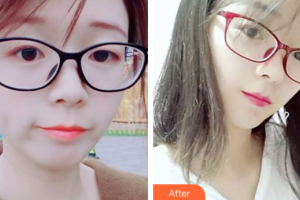 惠州元辰醫(yī)療美容門診部葉明龍整形價格表附水氧活膚案例展示