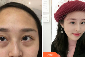 惠州伊麗莎白整形美容醫(yī)院劉本清整形價格表附祛眼袋案例展示