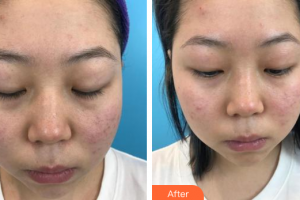 惠州市中心人民醫(yī)院整形燒傷科黃穎江整形價格表附紅藍(lán)光祛痘案例展示