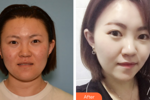 惠州市中心人民醫(yī)院整形燒傷科黃建華整形價格表附清潔祛痘案例展示