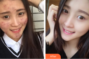 惠州市中心人民醫(yī)院整形燒傷科陳奇鳴整形價格表附紅藍(lán)光祛痘案例展示