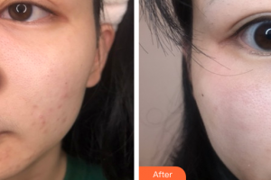 惠州市中心人民醫(yī)院整形燒傷科徐俊賜整形價格表附果酸煥膚案例展示