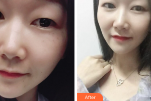 惠州伊麗莎白整形美容醫(yī)院鄧蕓整形價格表附激光祛斑案例展示