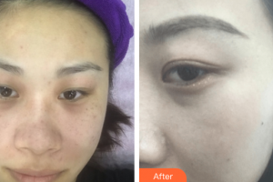 中信惠州醫(yī)院醫(yī)學(xué)整形中心柏松整形價格表附超激光美膚+祛斑針案例展示