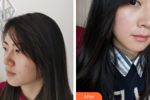 中信惠州醫(yī)院醫(yī)學(xué)整形中心何輝整形價格表附果酸換膚案例展示